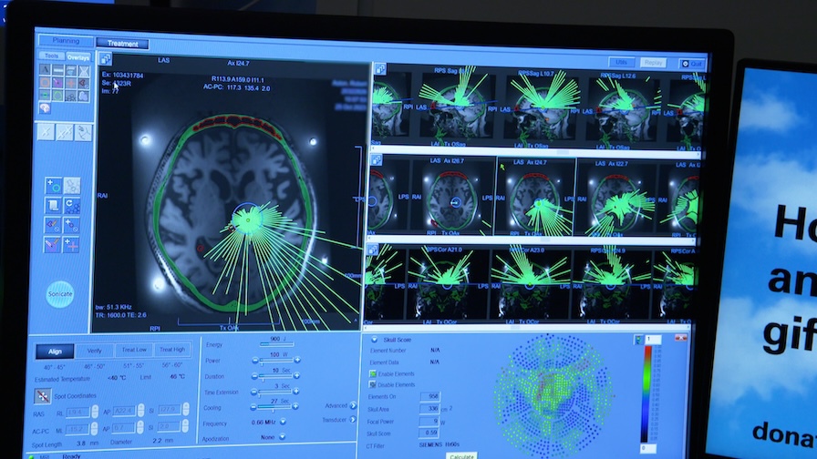 The MRI results on a. computer screen show multiple ultrasound energy beams focused in at one spot on the brain. 