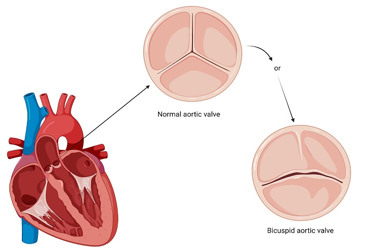 Illustration of heart cross-section with examples of normal and bicuspid aortic valves