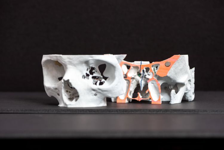 A 3D printed model of a skull in a complicated surgical case, showing the intracranial pathology. (Central Virginia VA Health Care System)