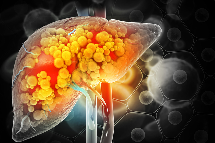 Illustration of Liver damage such as Fatty liver, Fibrosis, Cirrhosis, and Liver cancer. 
