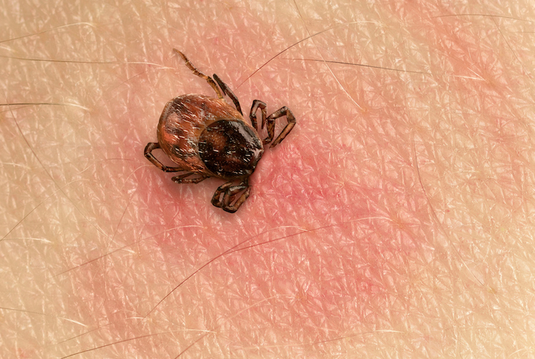 Tick with its head sticking in human skin, red blotches indicate an infection.