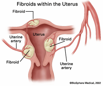 Illustration of fibroids within the uterus.
