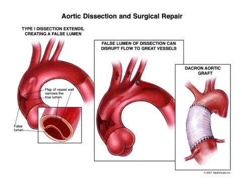 Diagram of aortic disease and surgical repair