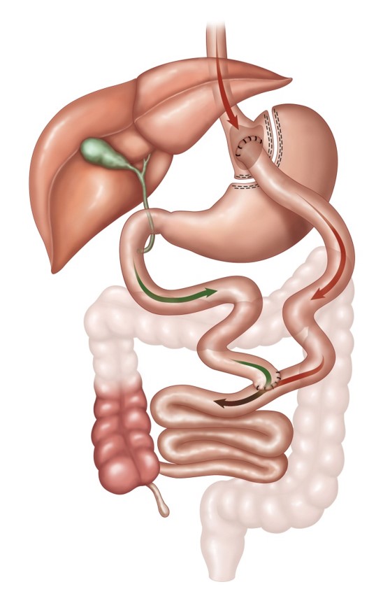 Illustration linking to Gastric Bypass page