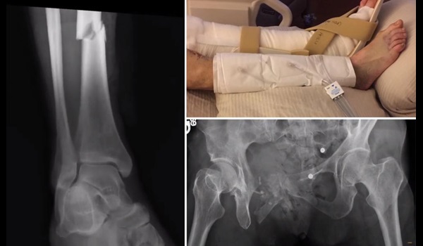 X ray of broken leg and pelvis. 