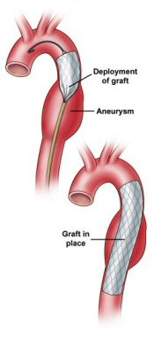 Diargram of aorta and grafts