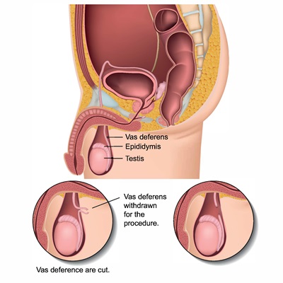 Illustration of where the vas deferens are cut during the vasectomy procedure