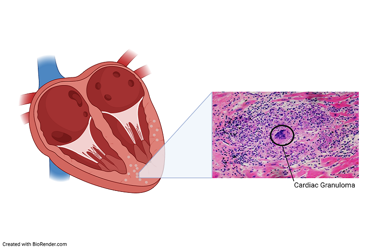 Illustration of a heart next to a picture of a Cardiac Granuloma (image created with Biorender.com)