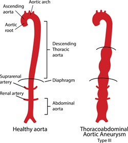 Aorta illustration