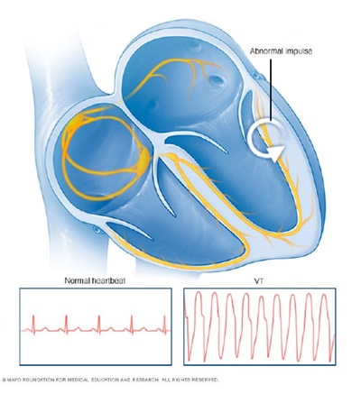 Irregular heartbeat illustration