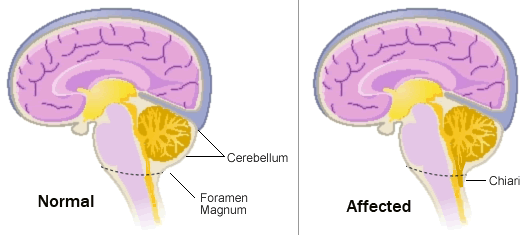 An illustration showing a normal brain and spine versus a brain and spine with Chiari malformation. In Chiari malformation, the cerebellum pushes into the spine.