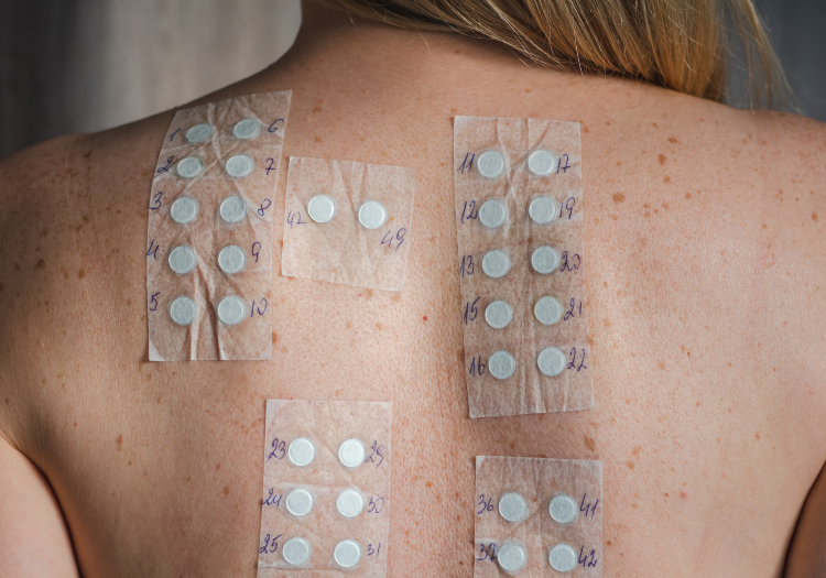 A person’s back with patches on the skin.