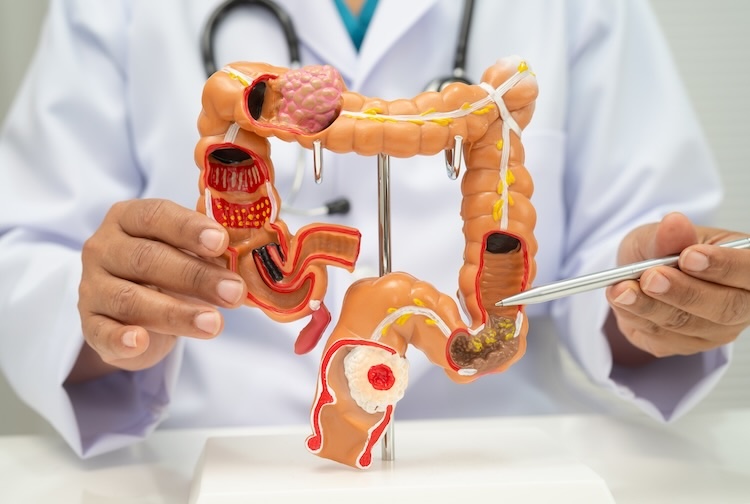 Colorectal cancer, doctor holding intestine colon human model.
