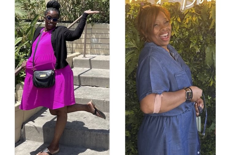 On the left, liver transplant recipient Stephanie is seen smiling while wearing a dress that covers her cystic liver. On the right, post-operation, she is smiling and looking healthy.