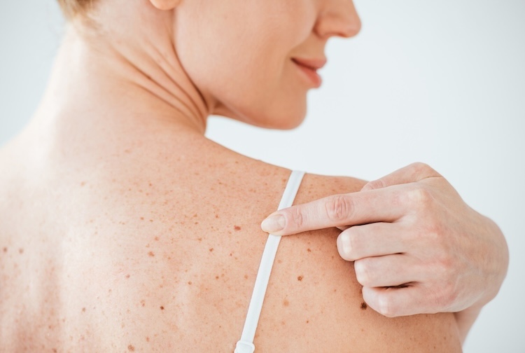 Woman with freckles pointing to a spot on her back