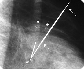A view of a patient with microcalcifications.