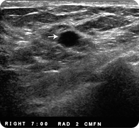 A possible cyst in the patient's breast.