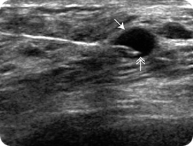 A cyst aspiration.