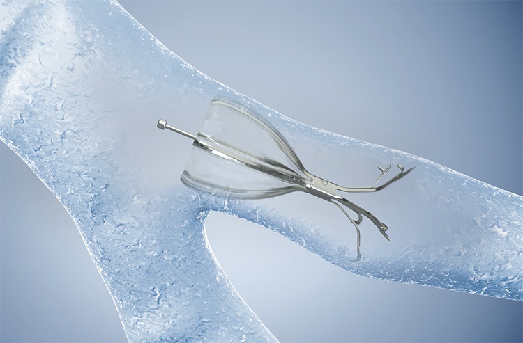 Olympus Spiration Valve traveling through airway