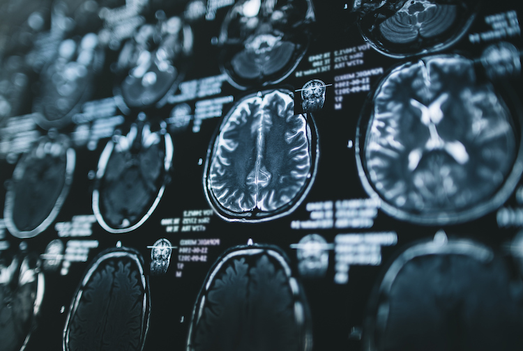VCU-led study will examine how traumatic brain injuries impact Alzheimer’s disease development